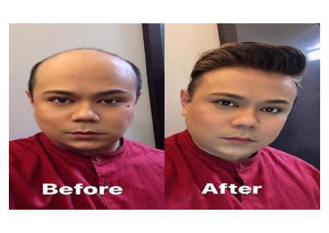 Hair transplant in singapore