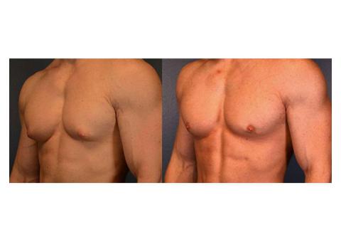 Regain Your Confidence with Men Breast Surgery in Delhi