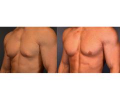 Regain Your Confidence with Men Breast Surgery in Delhi / 1